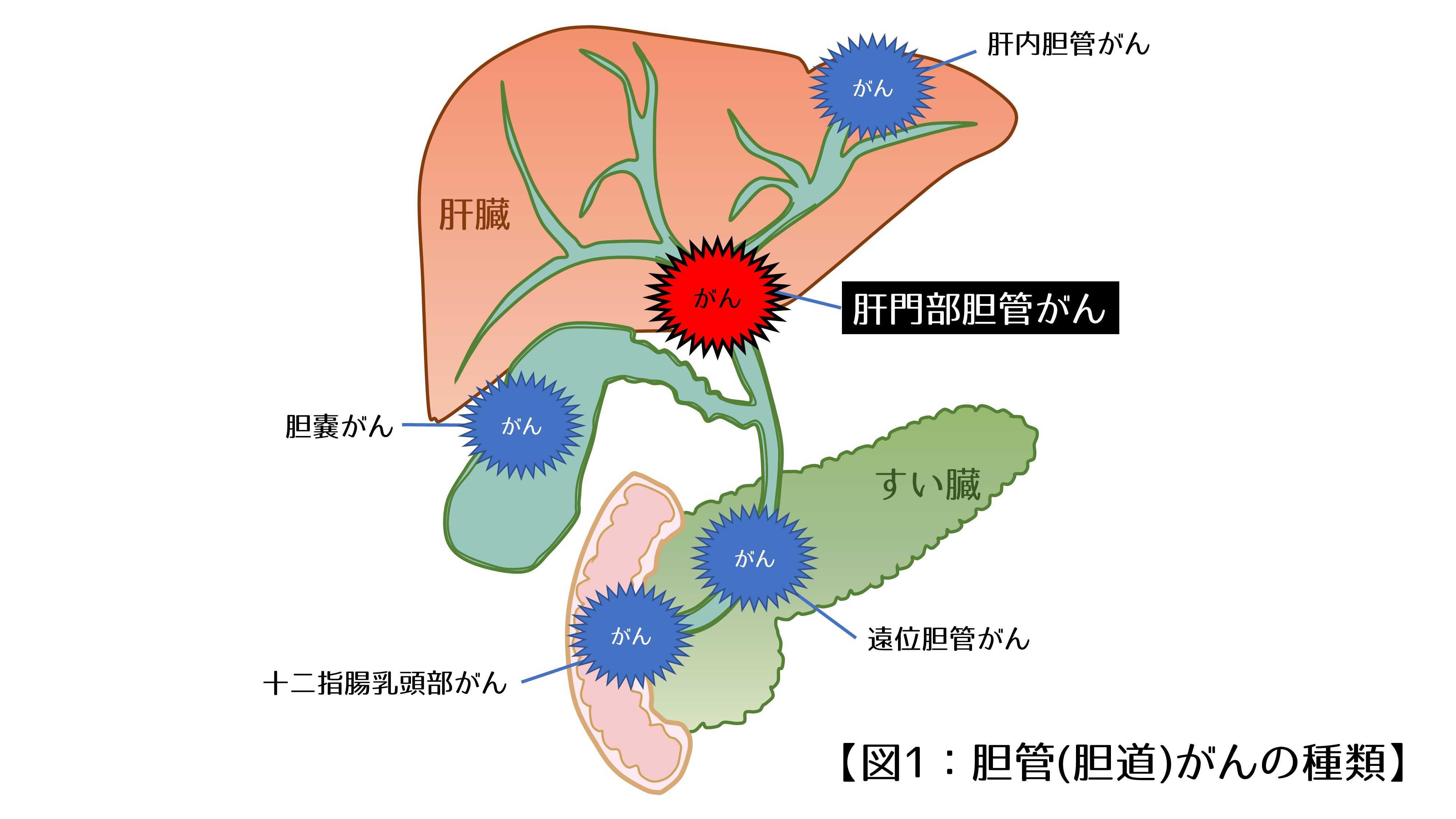 胆总管ct正常图解,肝内胆管扩t图片,肝总管和胆总管示意图_大山谷图库