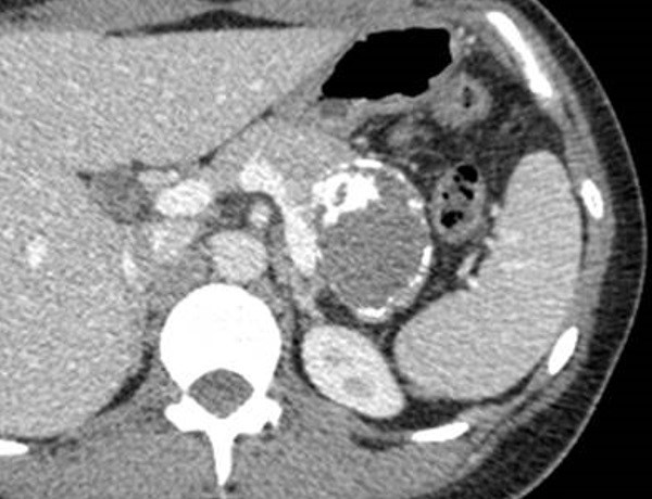 図. Solid-Pseudopapillary Neoplasm（SPN）とは？｜膵臓の病気と治療