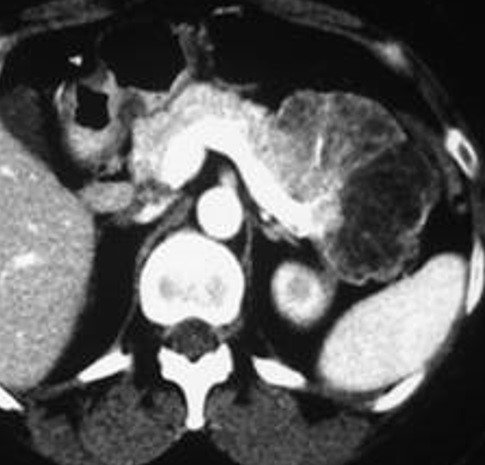 図. 漿液性嚢胞腫瘍（SCT, serous cystic tumor）とは？｜膵臓の病気と治療