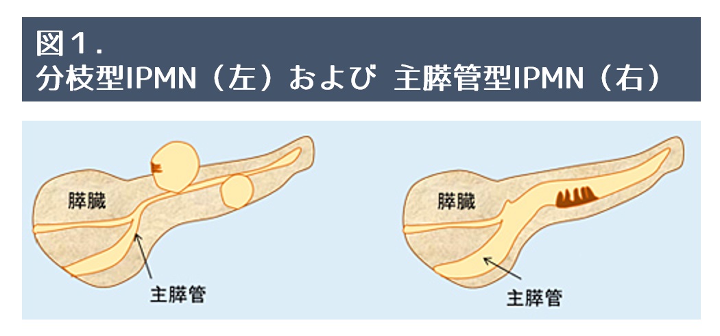 図1. 分枝型IPMN（左）および 主膵管型IPMN（右）｜膵臓の病気と治療