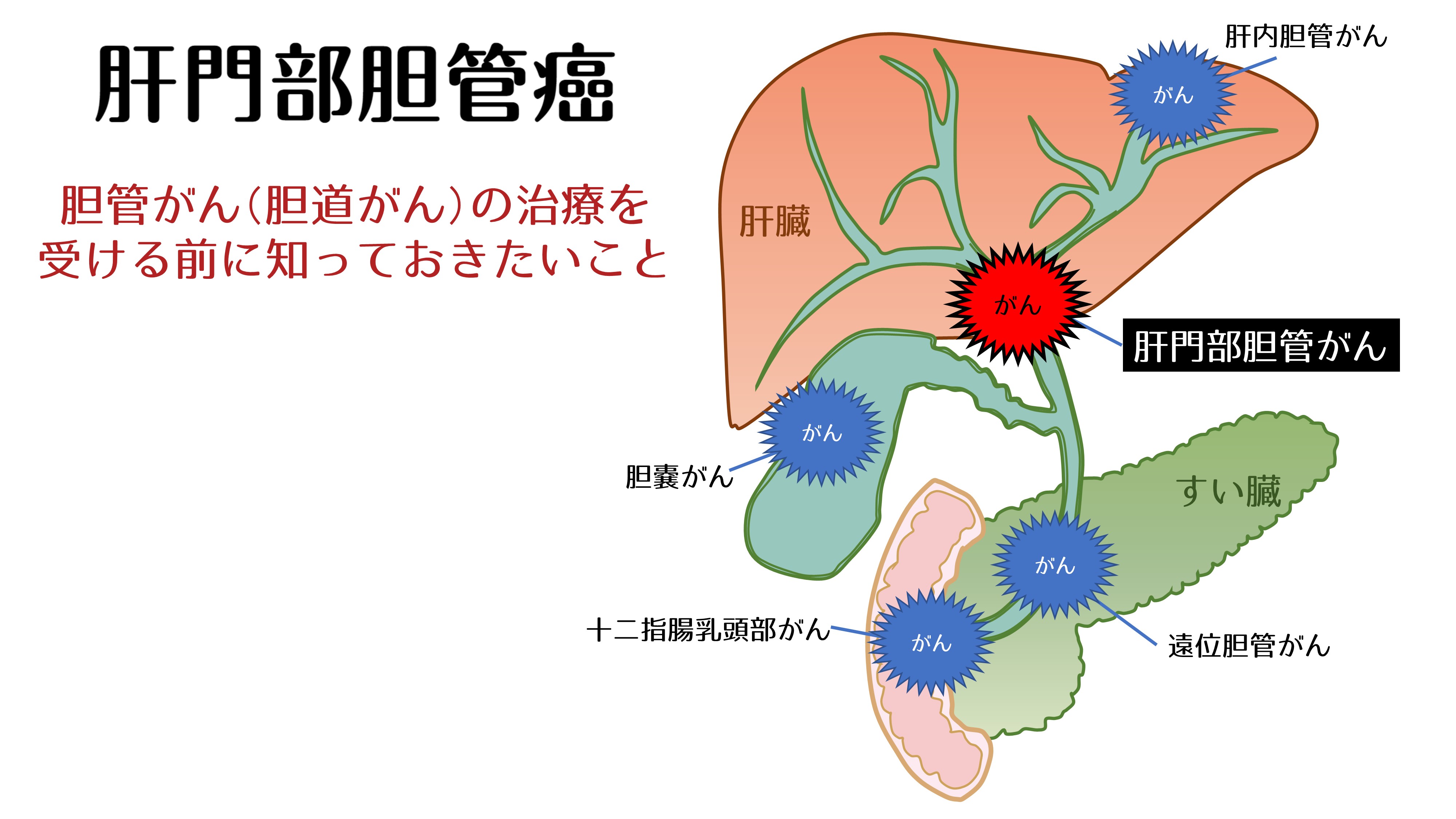 肝門部胆管癌