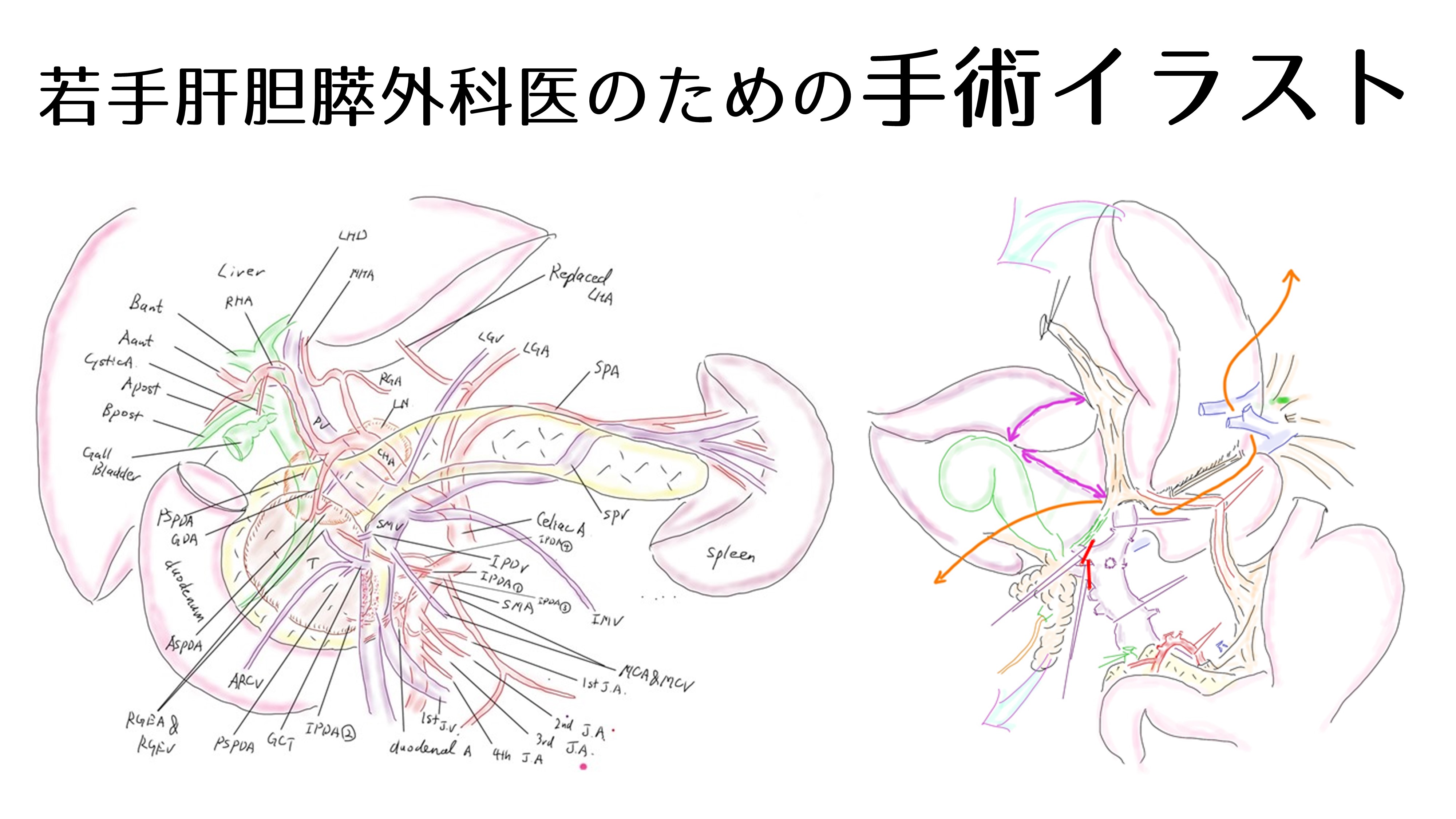 若手肝胆膵外科医のための手術イラスト