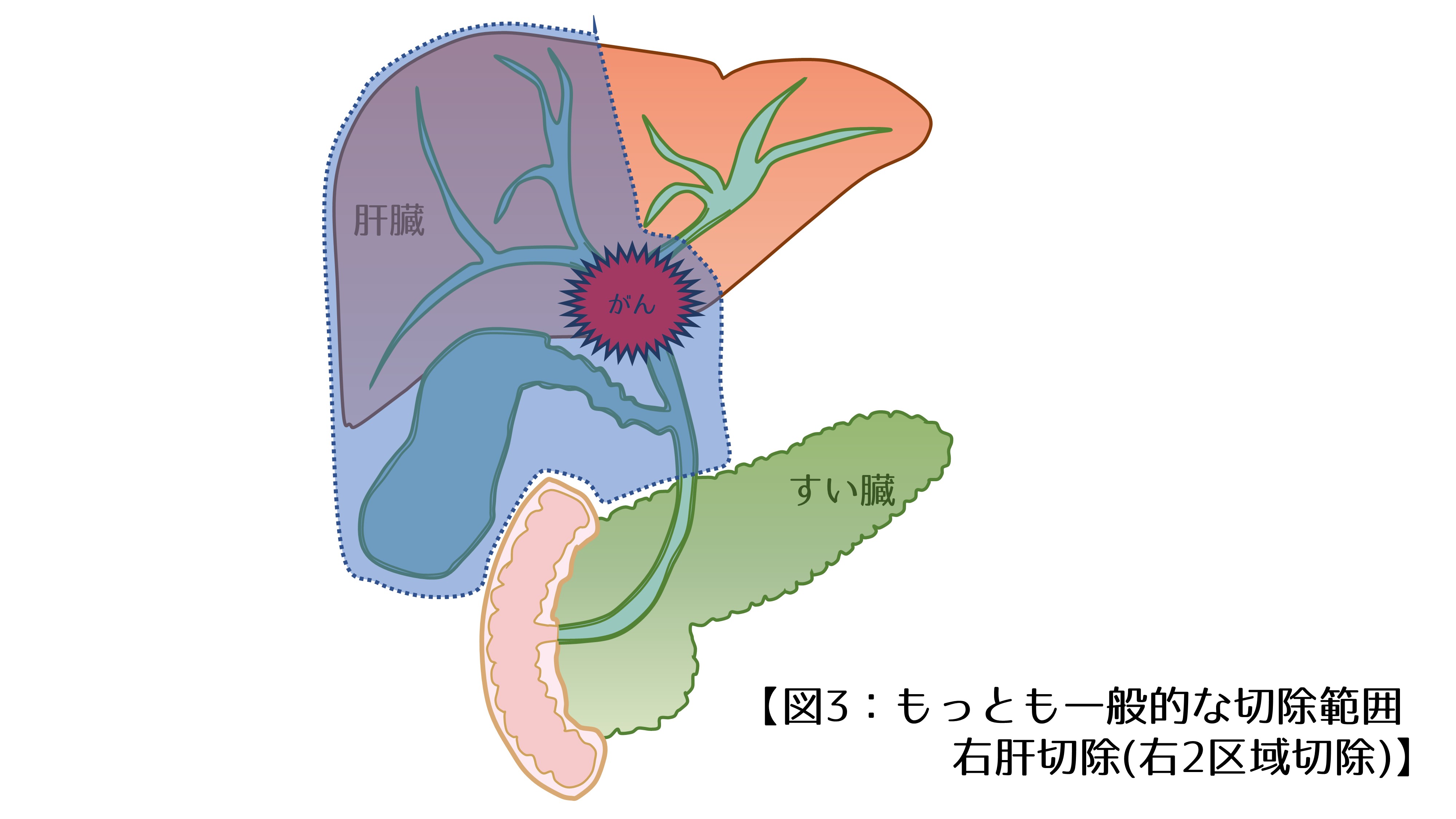 肝细胞癌合并胆管癌栓1例报告