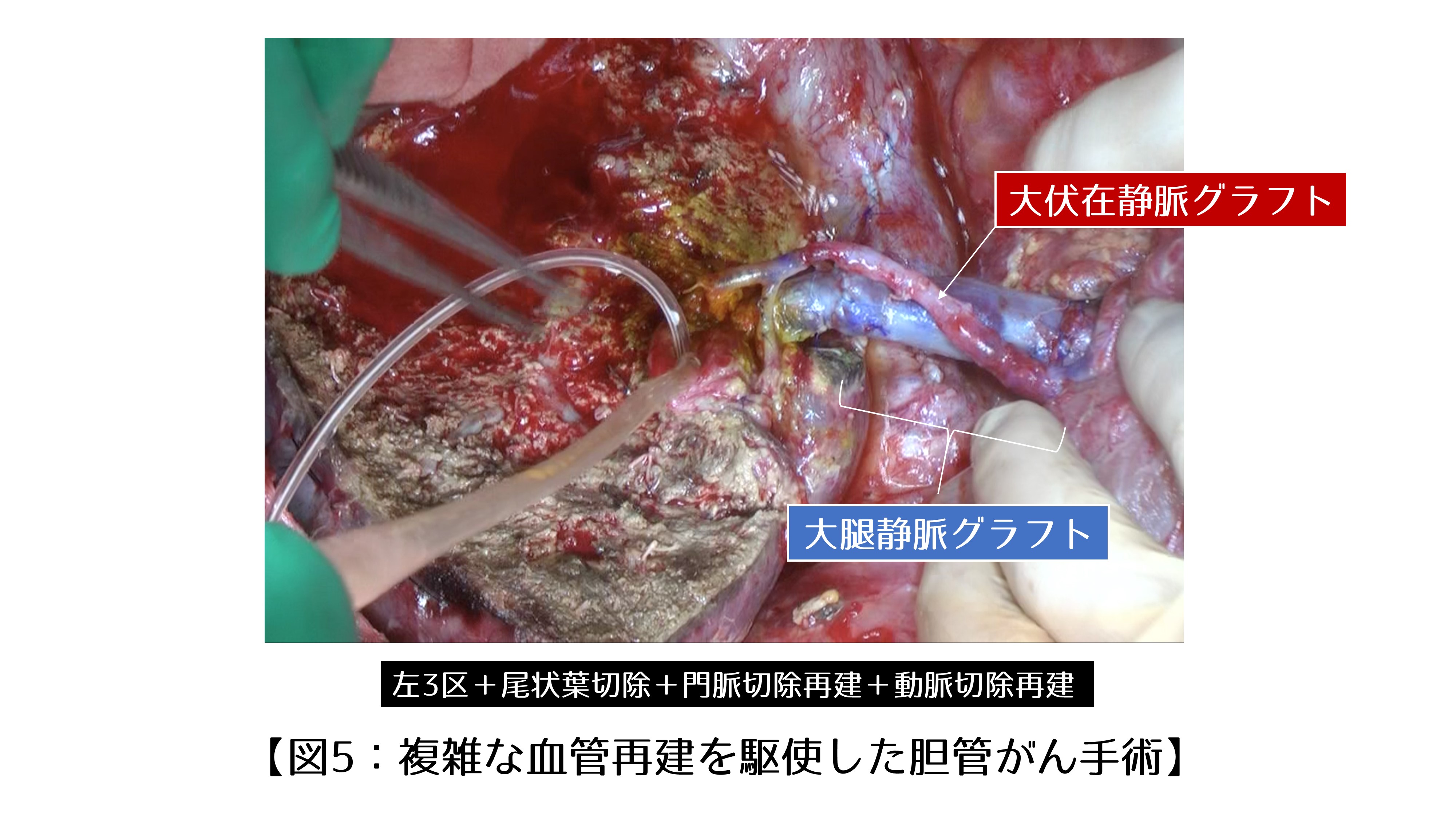 図5.複雑な血管再建を駆使した胆管がん手術｜肝門部胆管がん