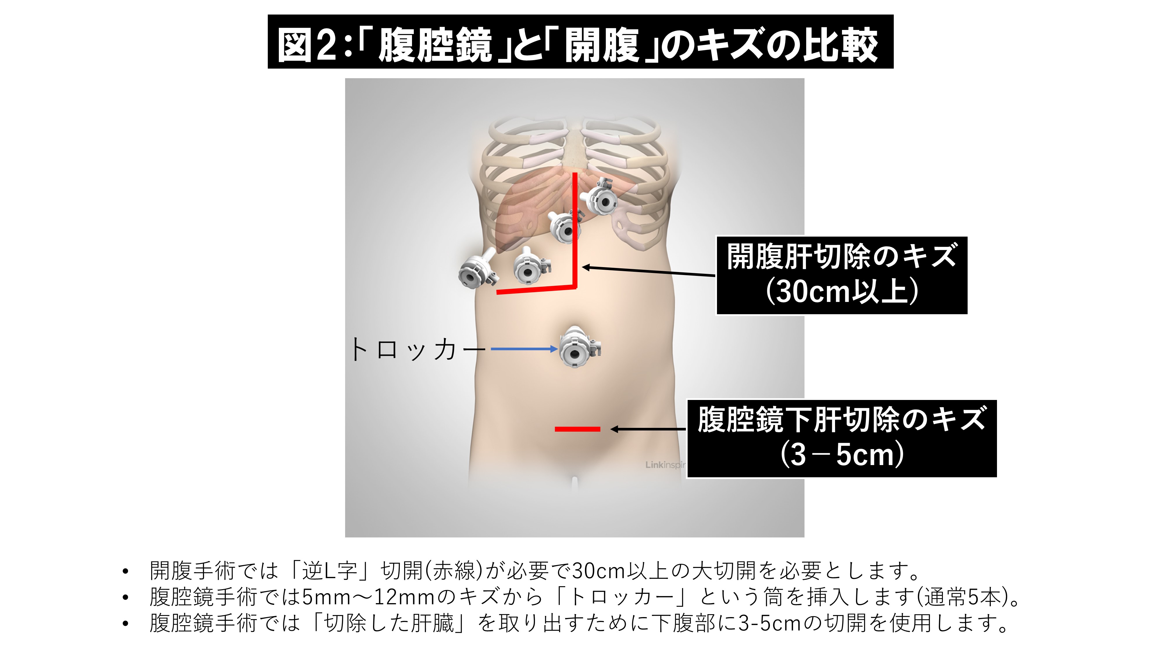 図2.「腹腔鏡」と「開腹」のキズの比較｜腹腔鏡下肝切除