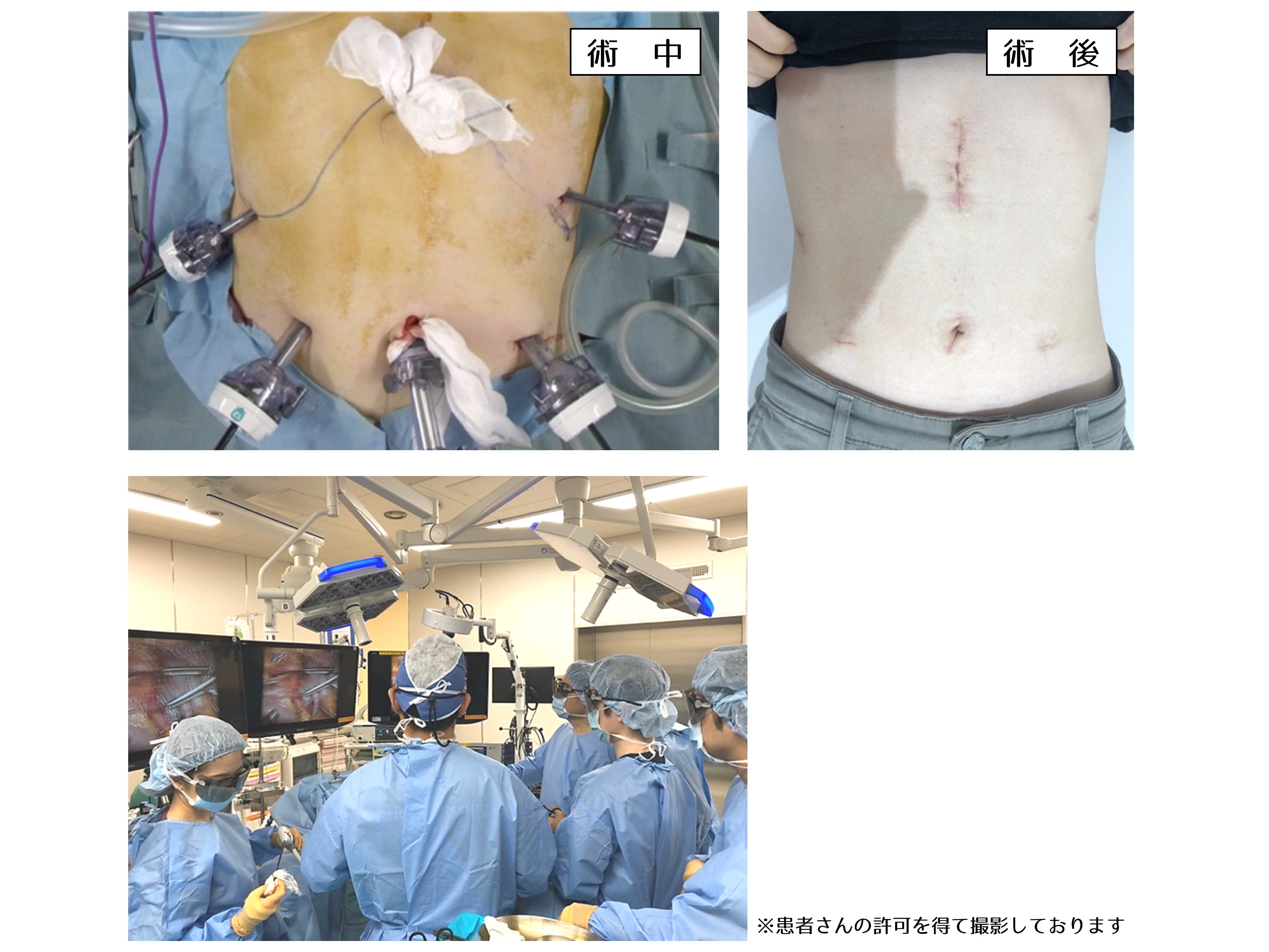 図4.腹腔鏡下膵頭十二指腸切除｜腹腔鏡下膵切除