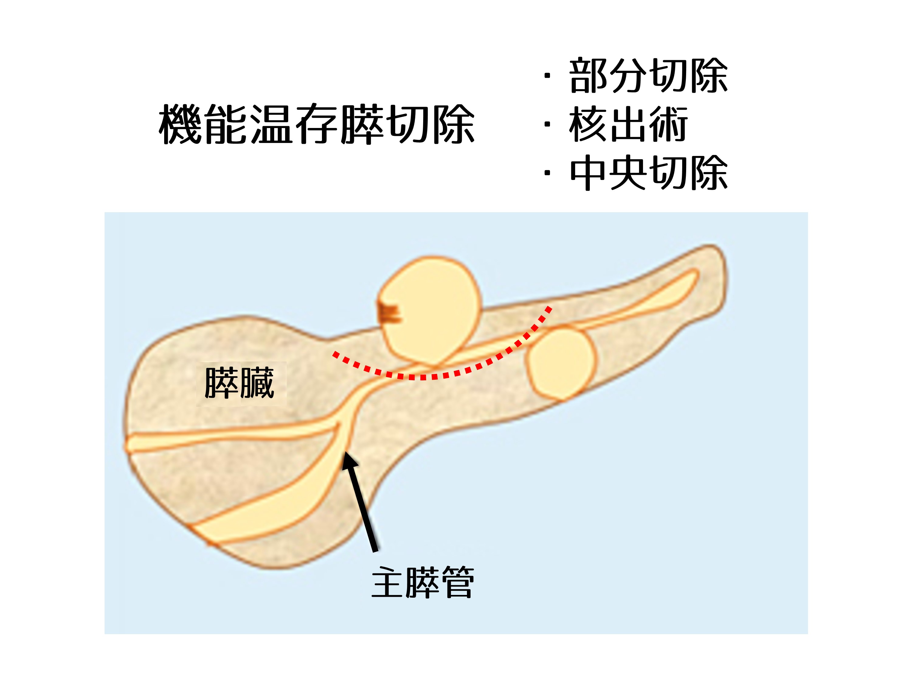 図5.機能温存膵切除｜腹腔鏡下膵切除