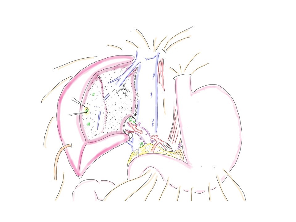 図3.若手肝胆膵外科医のための手術イラスト３